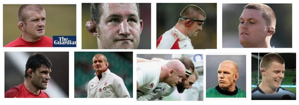 cauliflower ears rugby images