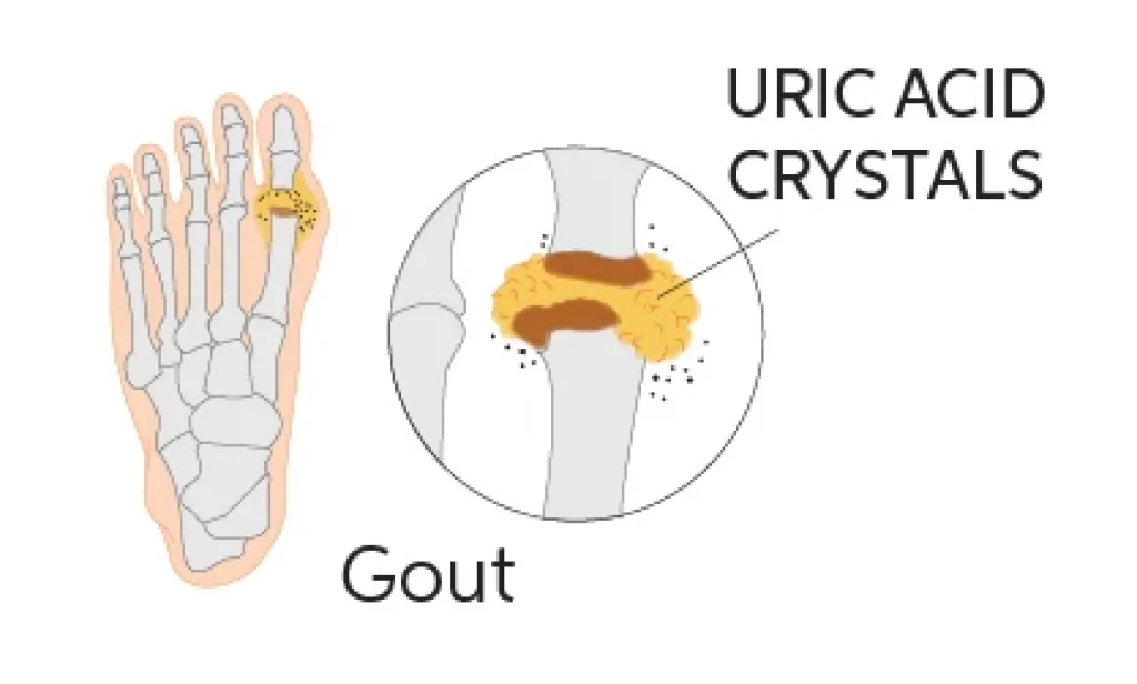 uric acid