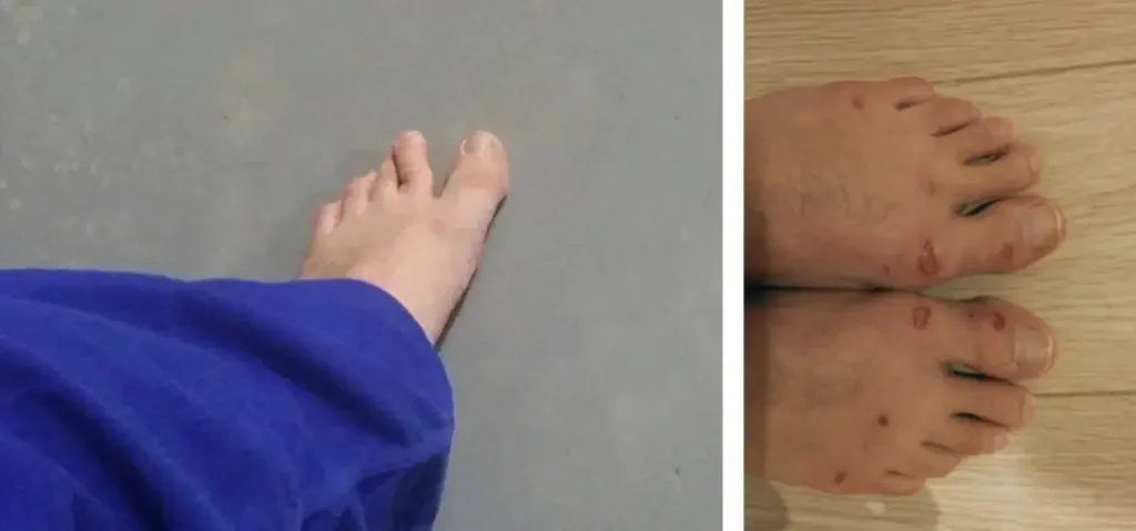 big toe injury bjj